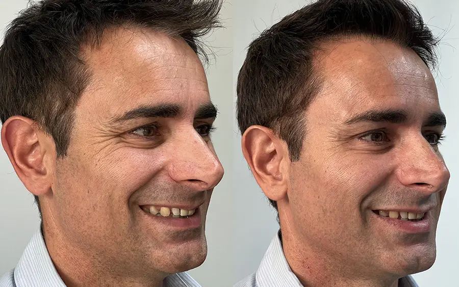 armonizacion-facial-majadahonda-arrugas-perfil-derecho-antes-y-despues