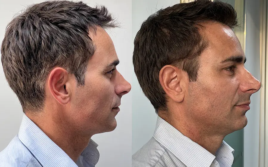 armonizacion-facial-majadahonda-pomulos-perfil-derecha-antes-y-despues-tratamiento