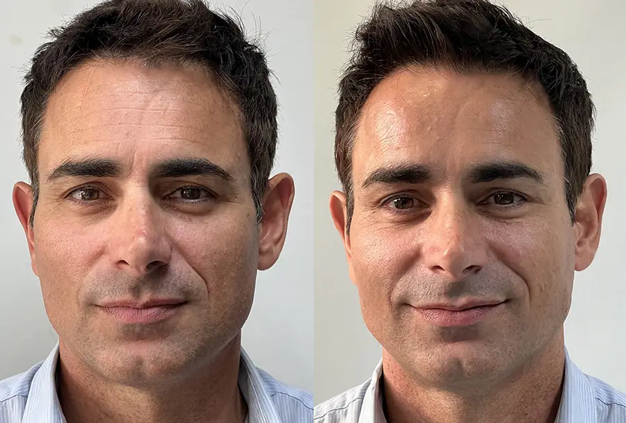 armonizacion-facial-majadahonda-pomulos-perfil-frontal-antes-y-despues-tratamiento